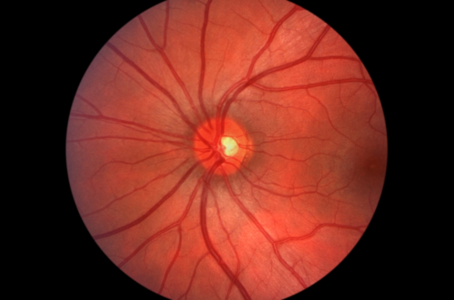 Angiografia Ocular com Indocianina Verde